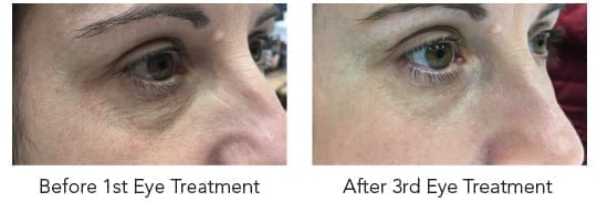 hydrafacial eye treatment