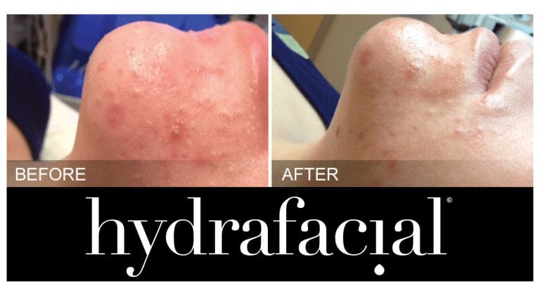hydrafacial acne treatment