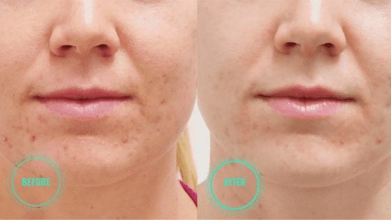 microdermabrasion before after