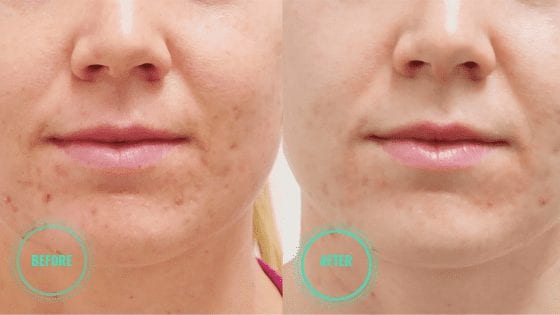 microdermabrasion before after